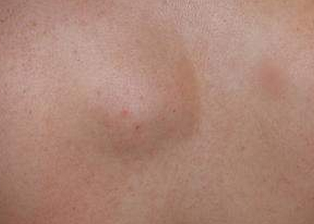 lipoma photos