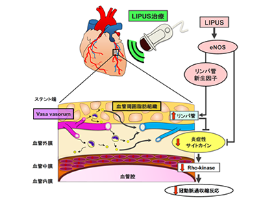 Lipus治療 冠動脈外膜のリンパ管新生促進と抗炎症効果をブタで確認 東北大 Qlifepro 医療ニュース