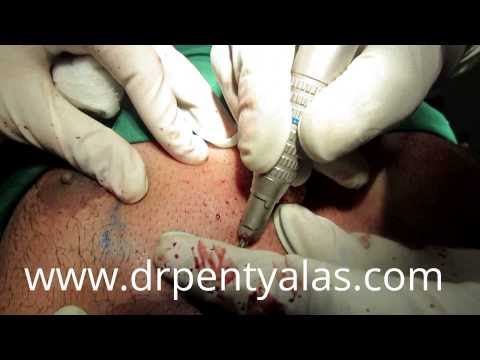 FUE Hair Transplant Using Body Hair