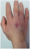 Early Stage Skin Cancer On Leg Pictures - Eight surprising lung cancer symptoms - Saga : See pictures of skin cancer and get the facts on skin cancer symptoms, signs, treatment, prevention, causes (tanning, genetics), and types (melanoma, squamous cell and basal cell carcinoma).