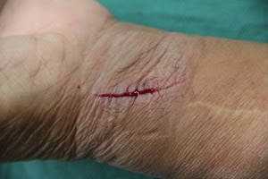 79歳 男性 左前腕裂創 なかのクリニック傷の治療症例