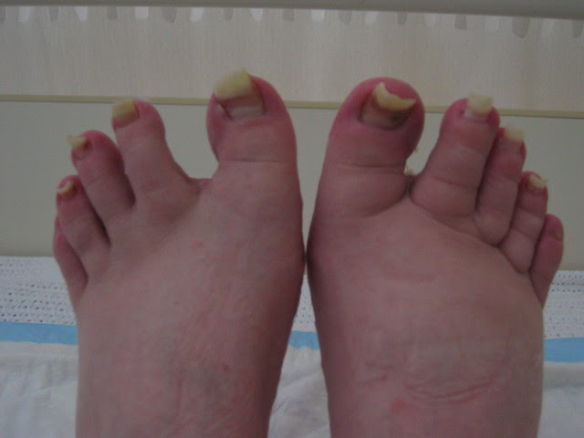 Chemo feet
