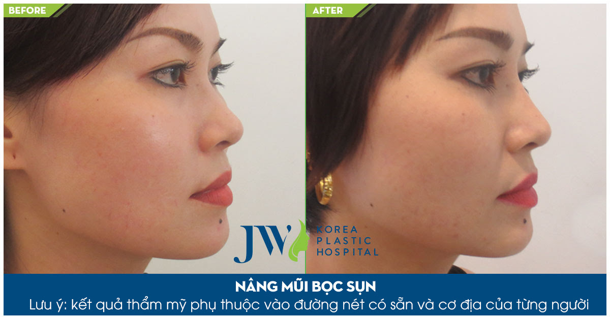Nâng mũi bọc sụn có được vĩnh viễn không