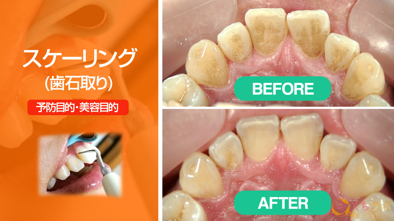 世界の常識 ニッポンの非常識 健康のための 歯のクリーニング 入門