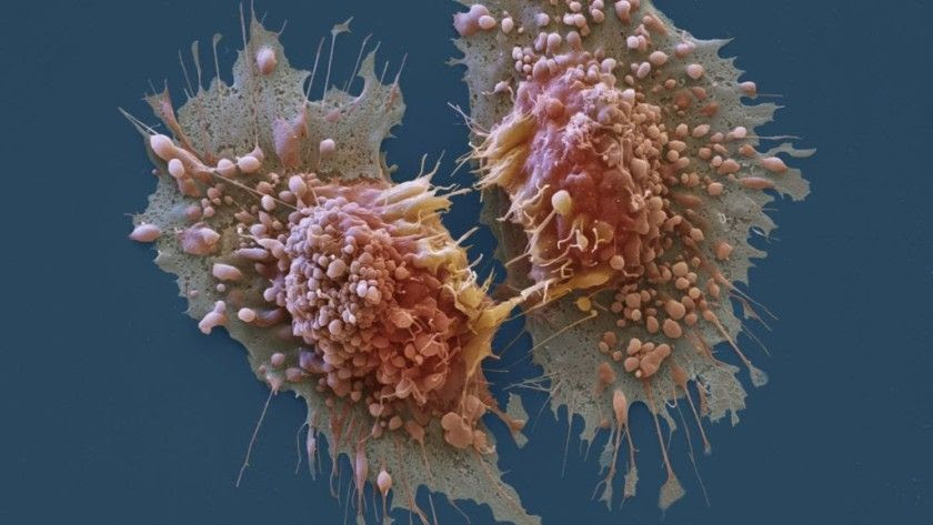 Luz para atacar directamente al cáncer, otra gran esperanza Luz para atacar directamente al cáncer, otra gran esperanza