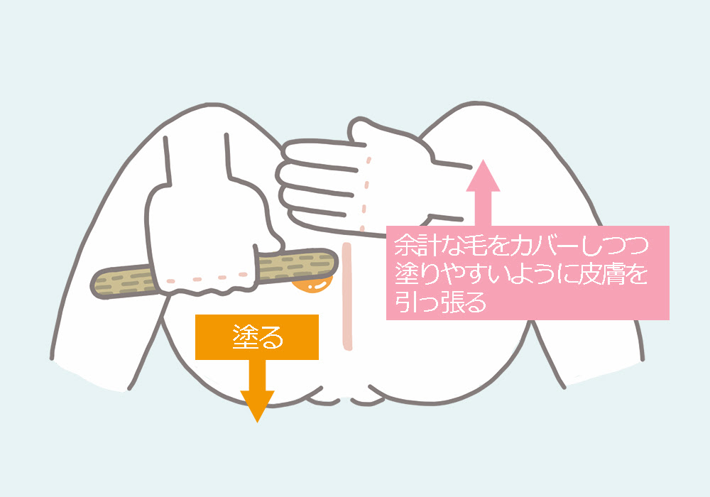 ｉラインの脱毛 難しい ｉラインのブラジリアンワックスで失敗しないコツ Angelica アンジェリカ