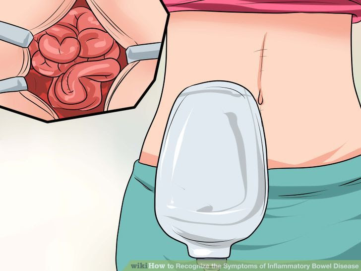 Recognize the Symptoms of Inflammatory Bowel Disease Step 11 Version 2.jpg