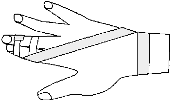 みんなのスポーツ医学1突き指だってばかにできない