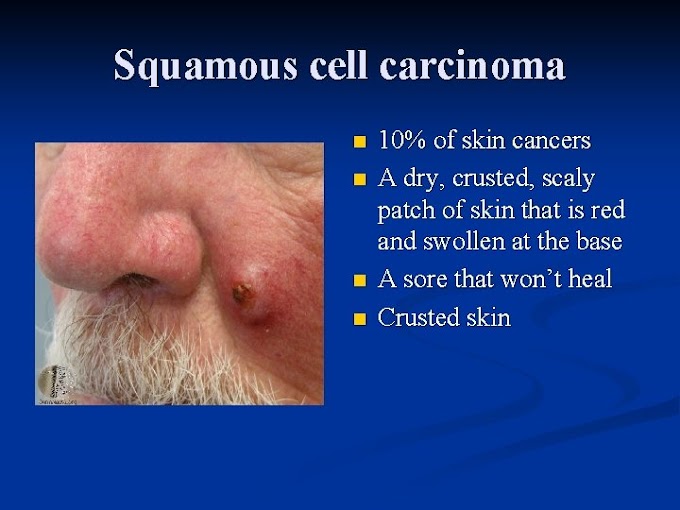 Skin Cancer Dry Scaly Patches - Skin Cancer Lesions And Sites 4d Skin Cancer Laser Clinic / Aks often appear as small dry, scaly or crusty patches of skin.