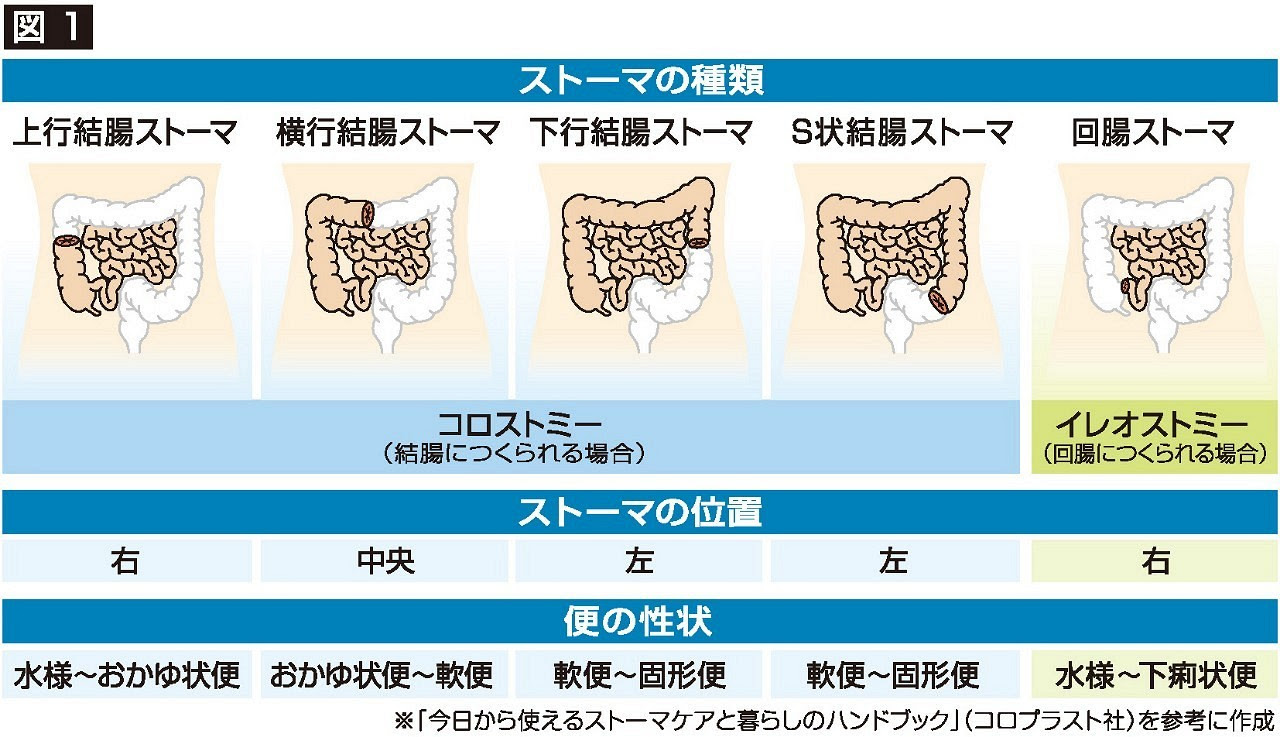 ４ ストーマについて チクバ外科 胃腸科 肛門科病院看護部病棟副主任 福島怜子 岡山の医療健康ガイド Medica