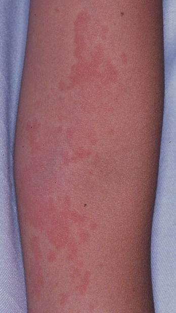 2 じんま疹じんましん じんま疹と湿疹はどんなふうに違うかといえば 次の表のとおりです じんま疹と湿疹の比較 じんま疹 かゆみのある赤み みずぶくれ 膨疹ぼうしん で ひっかいたり こすれると悪化します 圧迫部やこすれるところによく