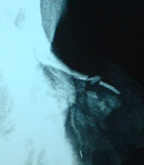 signs and symptoms of sinus surgical treatment