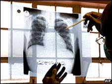 Radiografía pulmonar