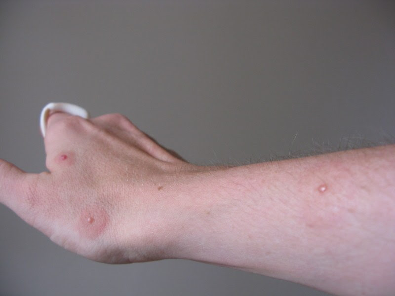 spider bites pictures australia. Spider Bites,