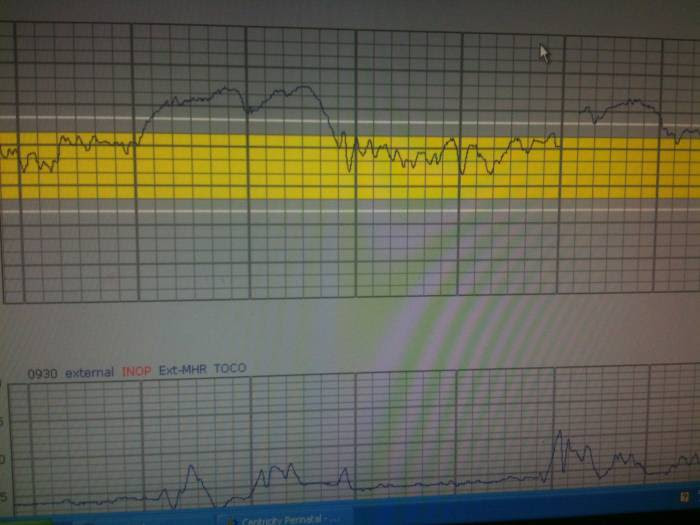 Fetal Heart Rate Monitoring