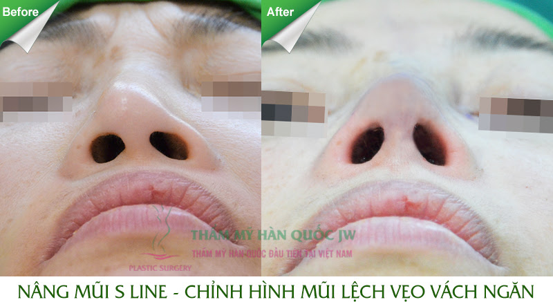 Tổng hợp hình ảnh thực hiện nâng mũi S line tại JW