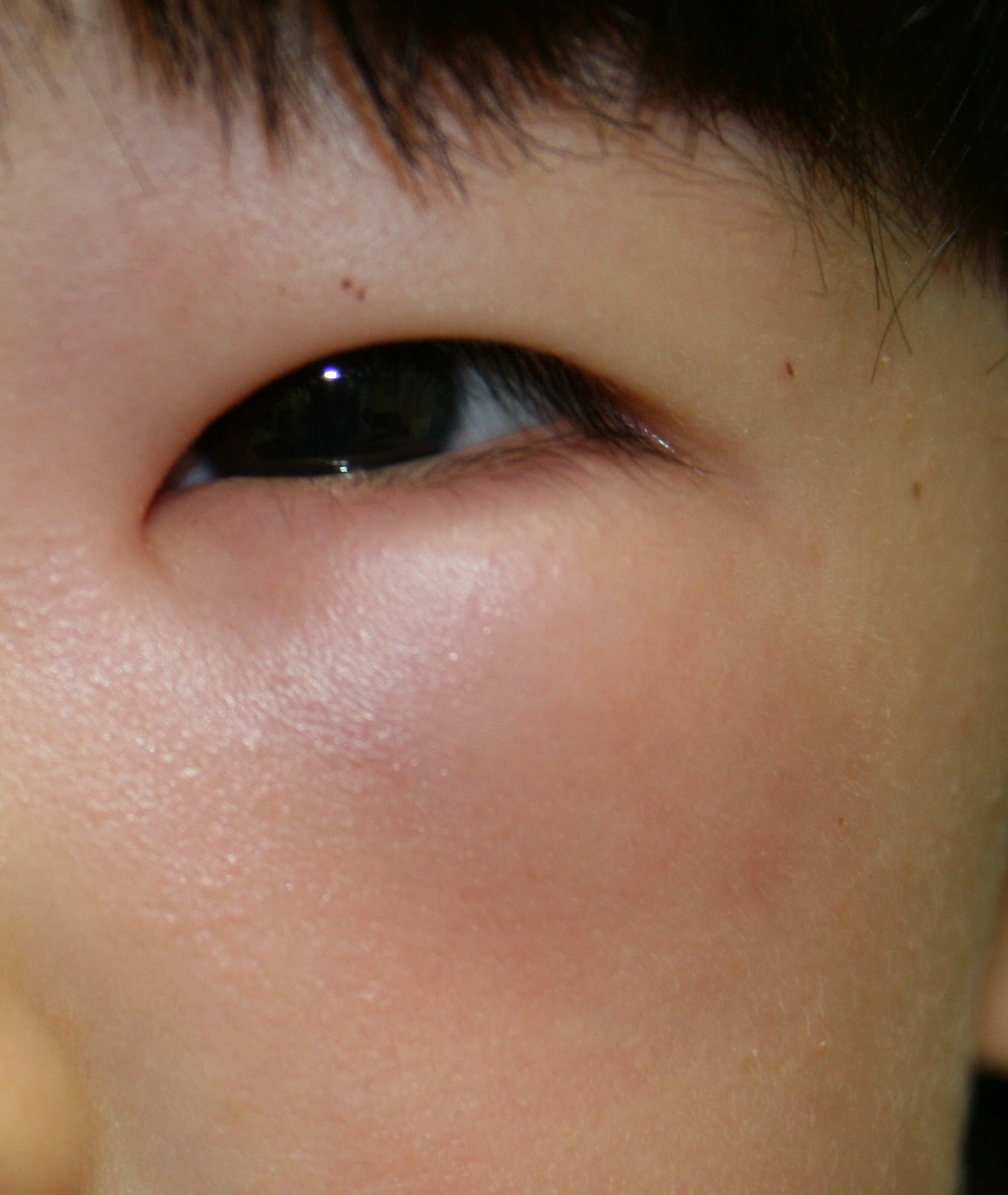 虫刺症ちゅうししょう 虫刺され