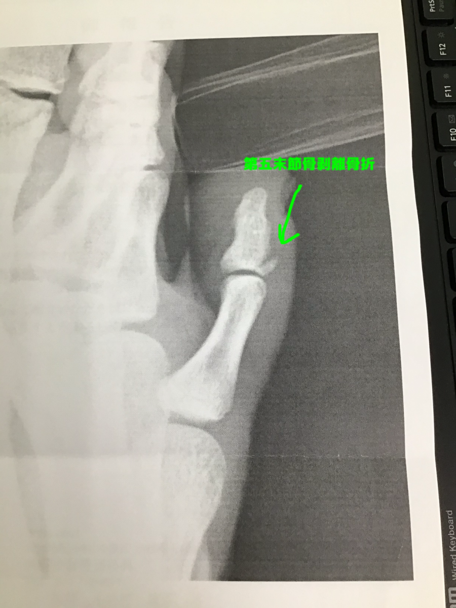 足の指の骨折 第五趾末節骨骨折 神奈川県川崎市の接骨院はむさしなかはら接骨院