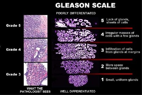 Prostate Cancer Stages Gleason 7 : Prostate Cancer Stages Gleason 7 - PSA test should be abandoned as