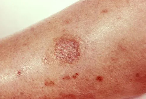 spider bite pictures. Brown recluse spider bite