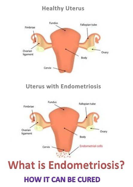 What is Endometriosis