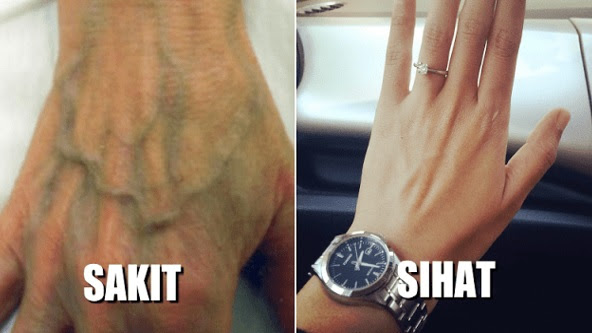 Urat Di Tangan Berwarna Hijau Petanda Ajal Semakin Dekat??