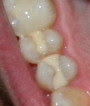 dental-fillings-composite filling