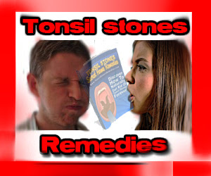 Tonsil Stones Cures Page 196