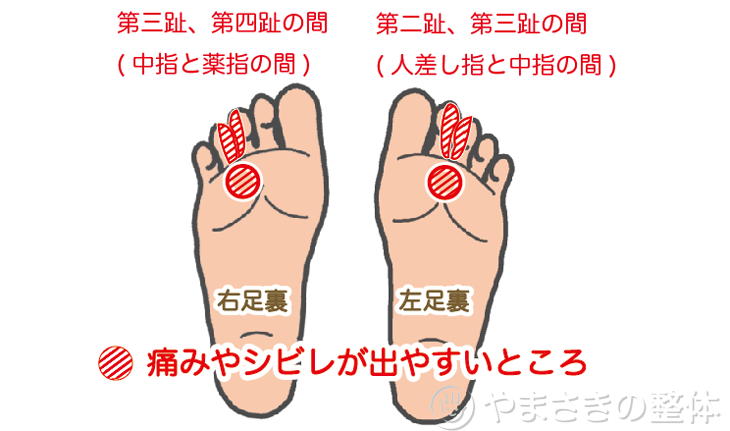 モートン病の改善 京都市中京区 やまさきの整体 慢性症状改善専門