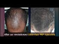 PRP HAIR TREATMENT YOUTUBE