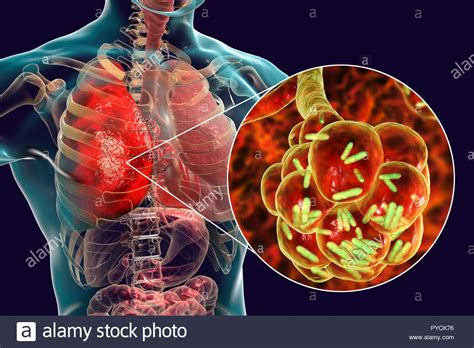 bacterial pneumonia computer illustration  rod shaped