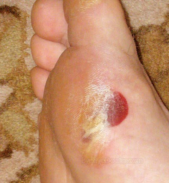blood blisters pictures 2 blood blisters pictures