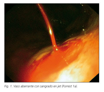 Hemorragia postoperatoria; Pérdida de Sangre Postoperatoria