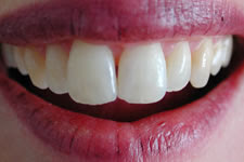 For The Ultimate in Whiter Teeth