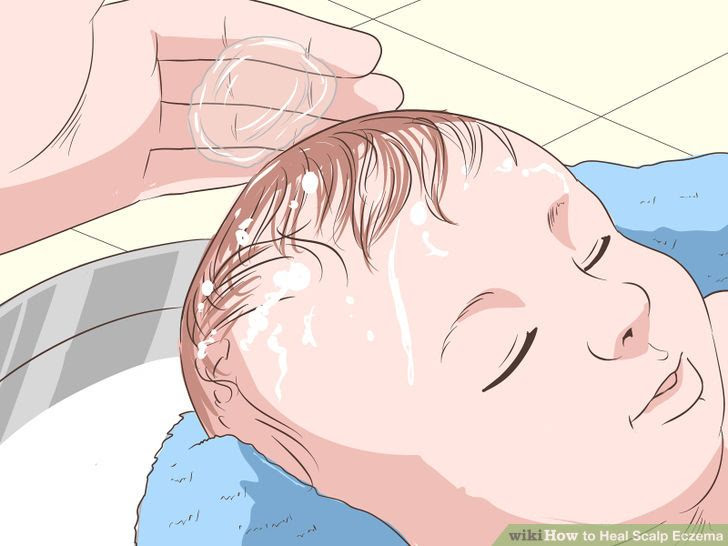 Heal Scalp Eczema Step 21 Version 3.jpg