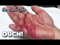 Infected Dog Bite On Hand