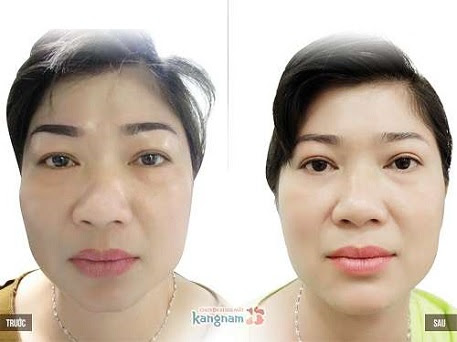 cắt mí mắt bị hỏng-6