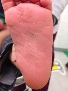 多形性滲出性紅斑