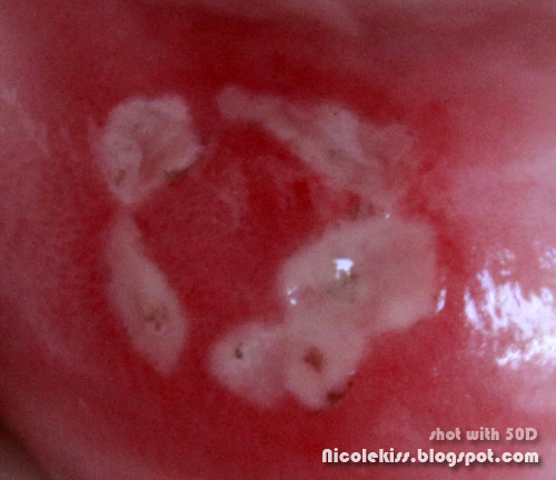five connecting ulcers