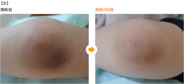 ボディqyagトーニング 乳輪 ワキ ソケイ部などの黒ずみ 名古屋タワーサイドクリニック