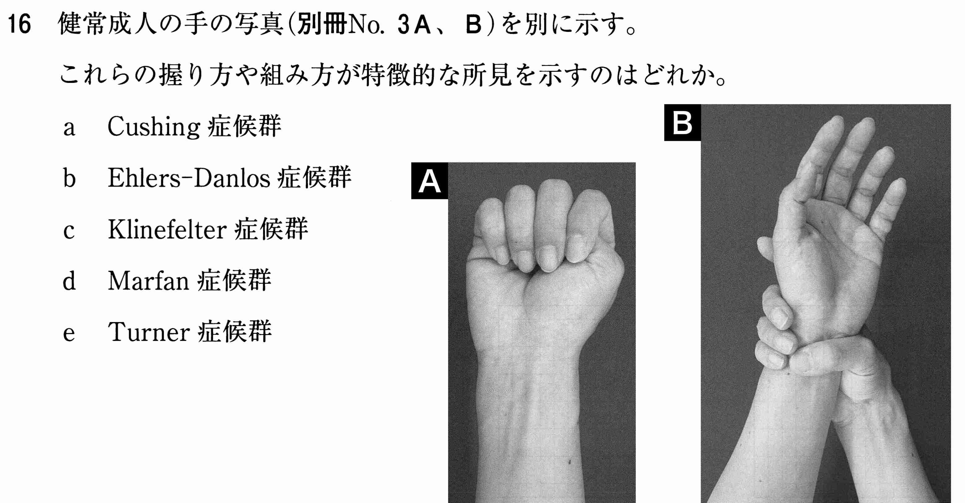 手の握り方 組み方が特徴的な所見を示す症候群 111医i16 医療関係資格試験マニア