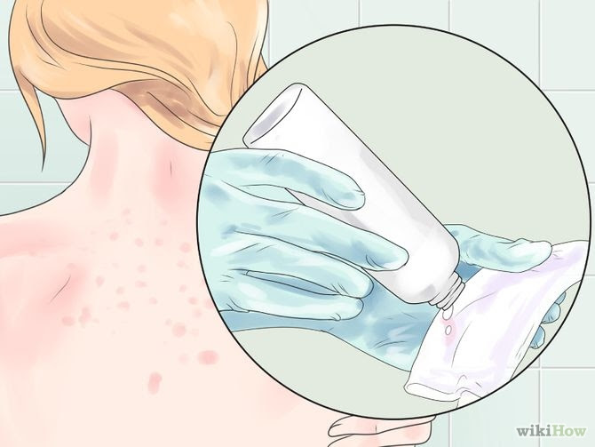Get Rid of Bacne Step 10 Version 2.jpg