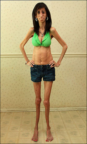 The Story of 21-year-old Lizzie Velasquez (17 pics) The Story of 21-year-old Lizzie Velasquez (17 pics)