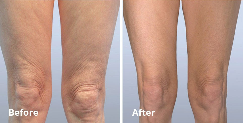 Forma Treatment For Sagging Skin | St. Louis Laser 