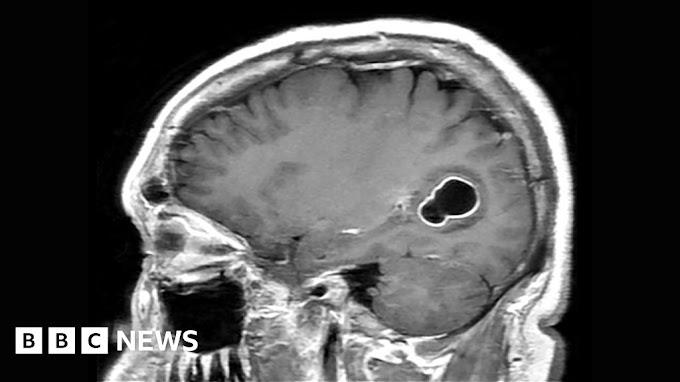 Tapeworm eggs in brain linked to undercooked bacon
