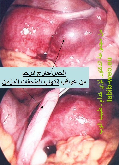 معلومات مهمة الجهاز التناسلي للانثى infection_h10.jpg معلومات مهمة الجهاز التناسلي للانثى infection_h10.jpg