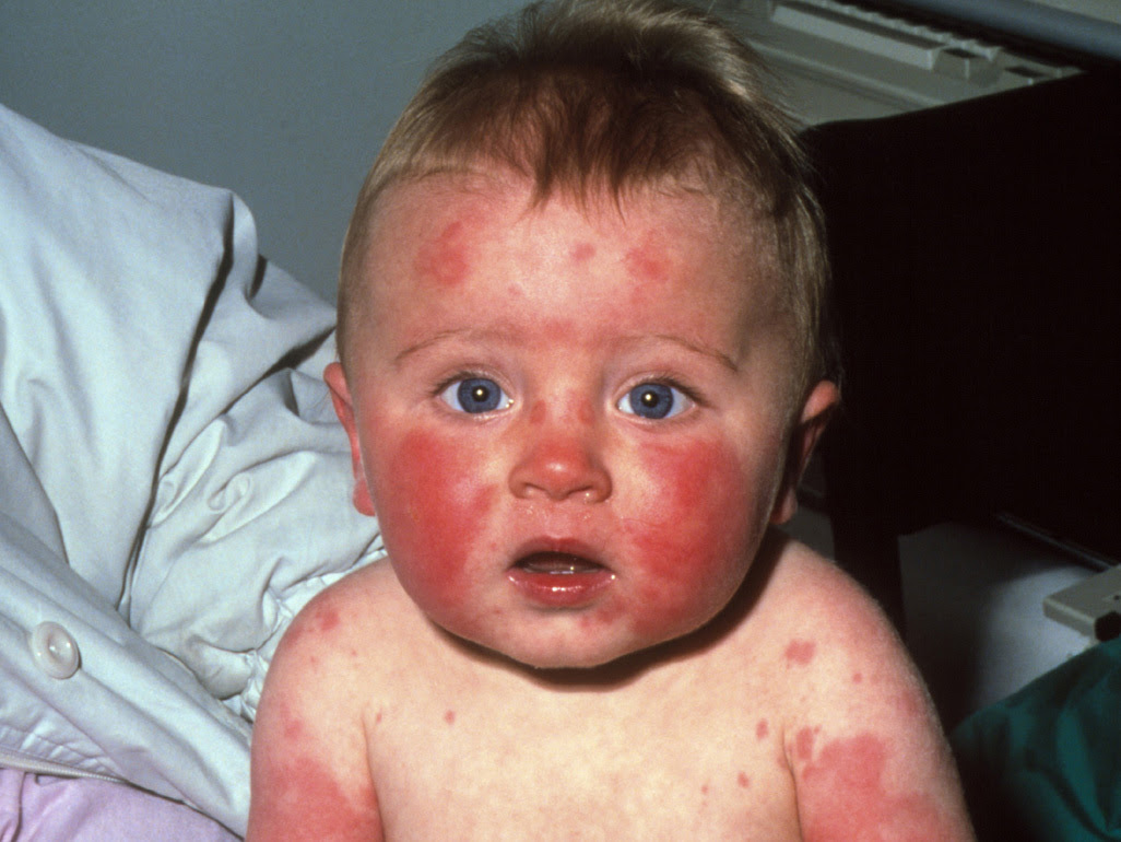 Fifth disease ("slapped cheeks" disease) | BabyCenter