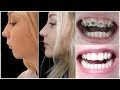Bagues Orthodontie Avant Apres