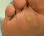 きらり皮フ科 たこ 魚の目 アトピー性皮膚炎に強い 皮膚科一般 小児皮膚科 アレルギー科 美容皮膚科 きらり皮フ科へ たこ 魚の目