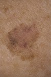 Skin Cancer Melanoma Pictures : Solar keratosis growth on forehead - Stock Image M190/0127 : In the united states, it’s estimated that doctors diagnose over 100,000 new skin cancer cases each year.